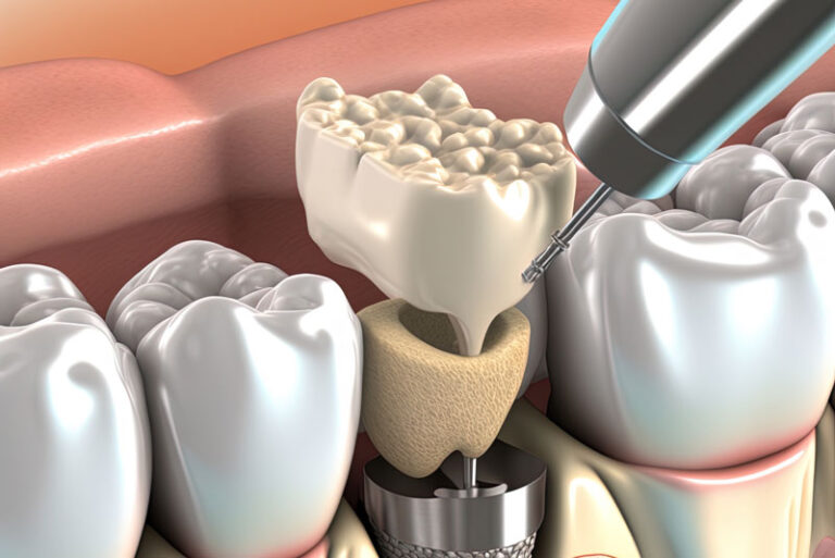 What Happens If I Don’t Have A Bone Grafting Procedure Before My Dental Implants Are Placed?