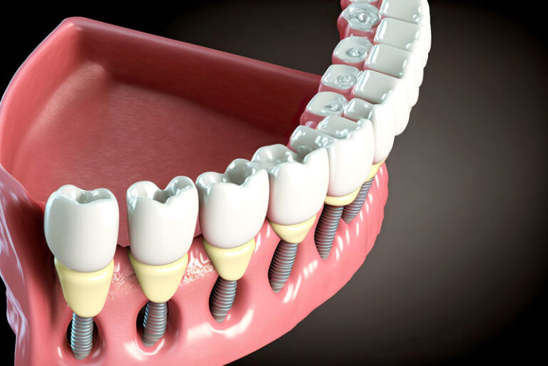 Are Dental Implants Able To Restore My Smile? 