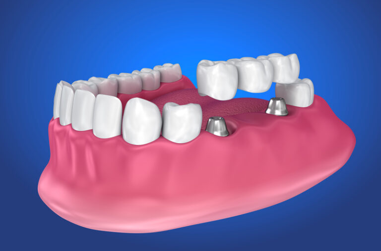 Am I A Candidate For Implant Supported Dentures? 