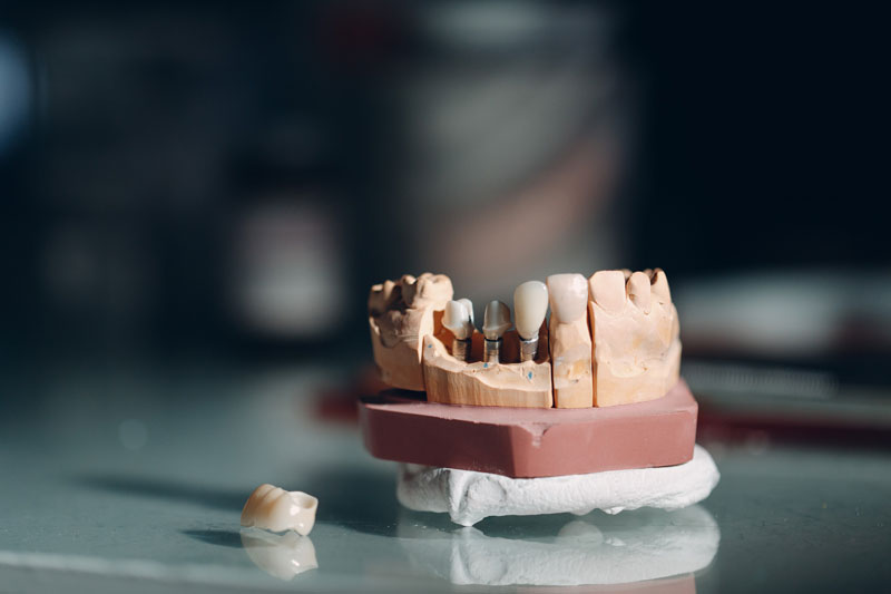 Dental layout of the human jaw with teeth and implants