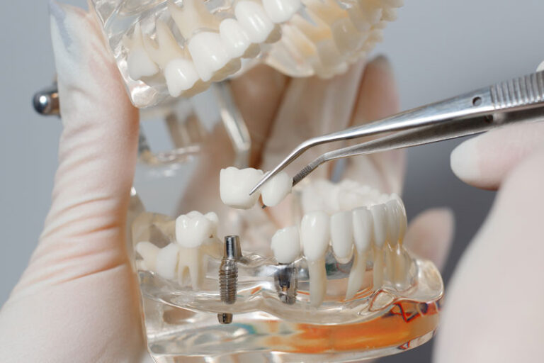  Why Can’t I Taste With Dentures, But Can With Dental Implants?