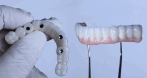 Full arch porcelain dental prosthesis on only 4 implants for completely edentulous jaws in dental jaw surgery and dentistry.