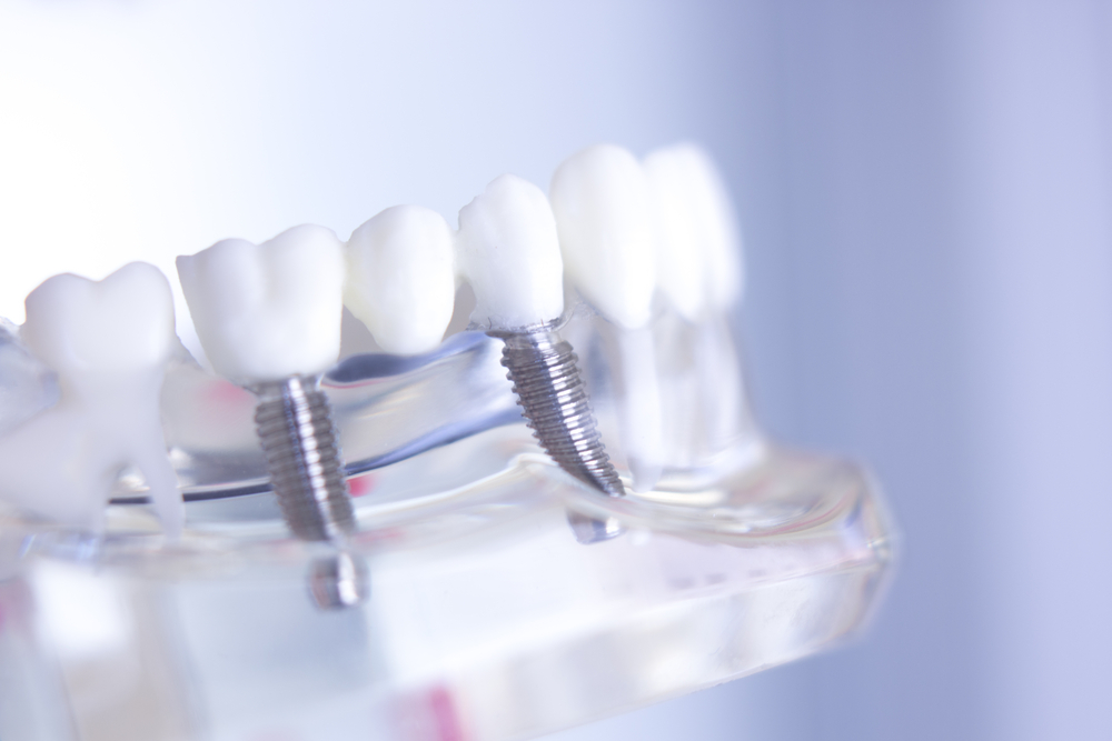 Dental professional showing a patient a dental implant model in an Austin office